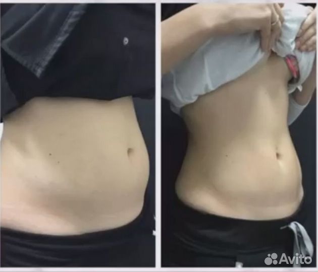 Электромагнитная стимуляция пресса (emsculpt)