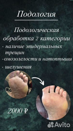 Подолог: педикюр, онихолизис, грибок, kart