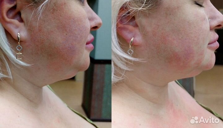 СМАС лифтинг