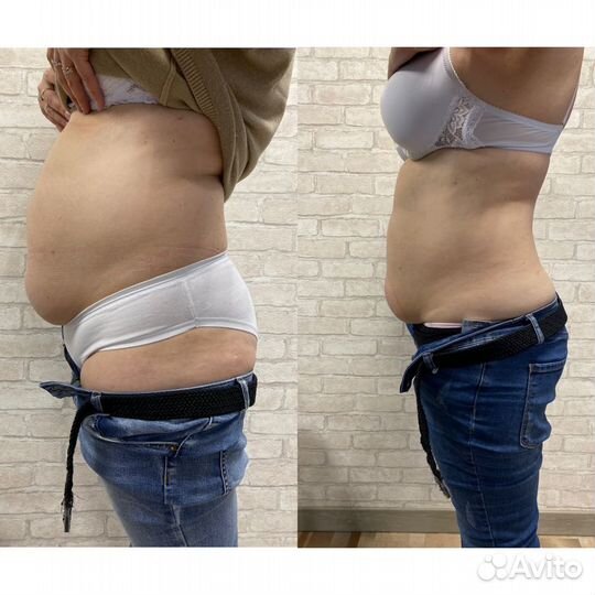 Криолиполиз в Красноярске