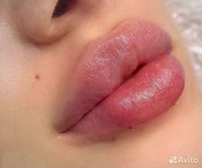 Контурная пластика губ,увеличение губ