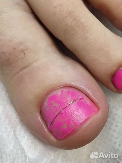 Педикюр маникюр вросший ноготь