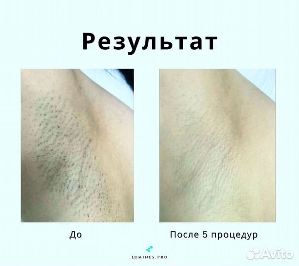 Диодный лазер для эпиляции люминес Max One 1200 Вт