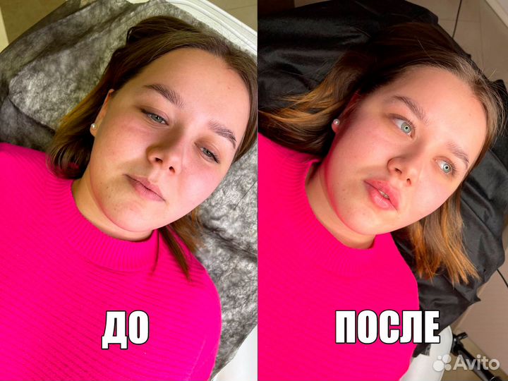 Контурная пластика