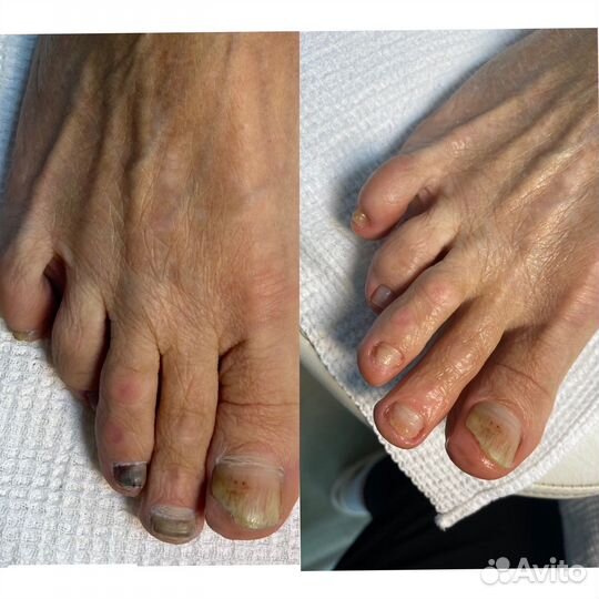 Медицинский педикюр. Подолог