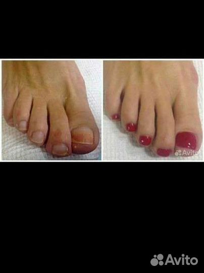 Педикюр, Подолог. Выезд на дом