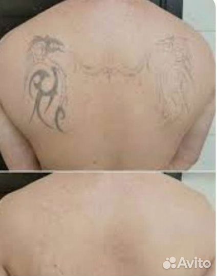 Лазерная эпиляция