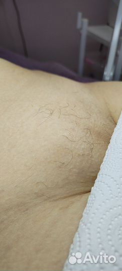 Электроэпиляция на аппарате Apilus/женская,мужская
