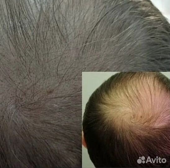 Трихопигментация, загущение волос