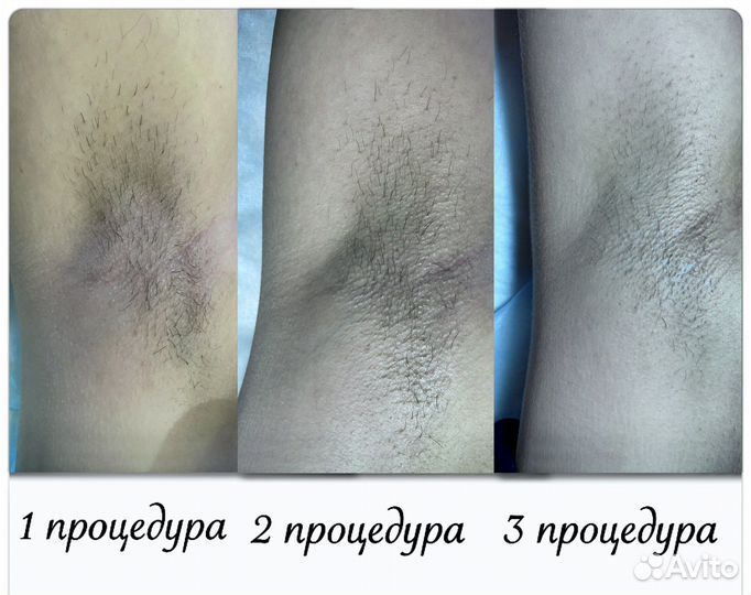 Электроэпиляция Ишим
