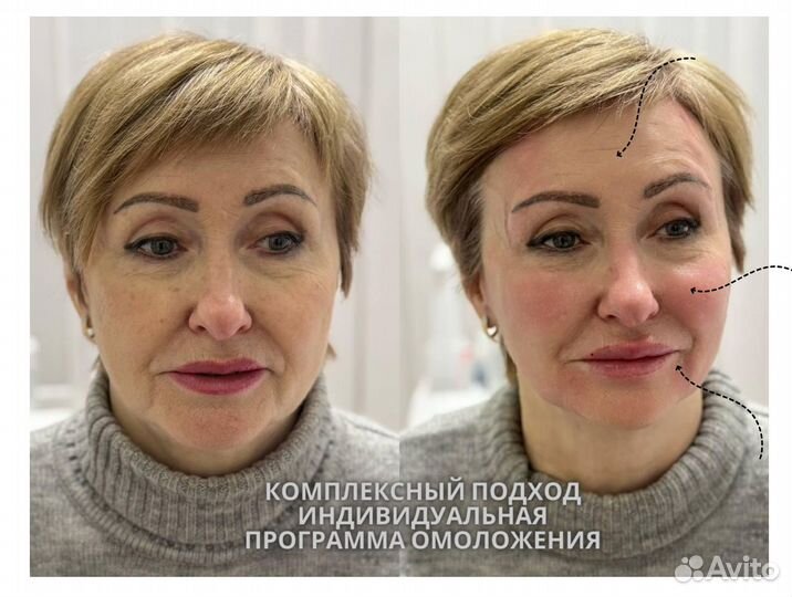 Комплексная программа омоложения лица