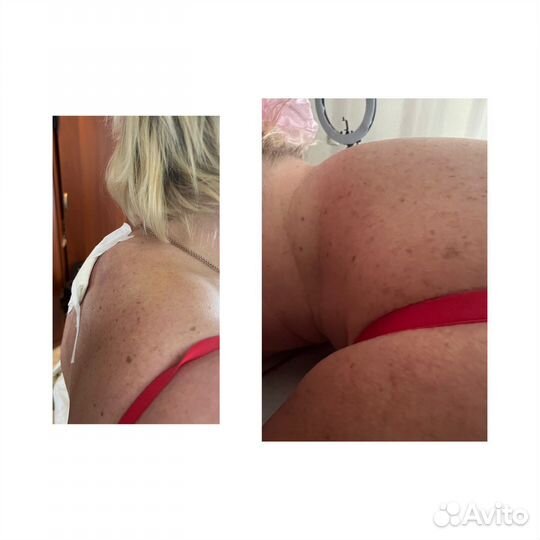 Липосакция аппаратная