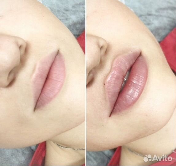 Модель на увеличение губ