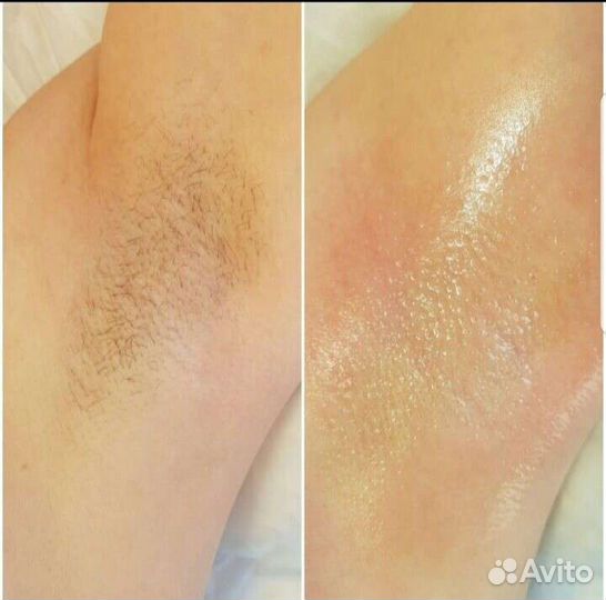 Шугаринг депиляция