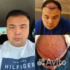 Пересадка волос без рубцов, швов и шрамов