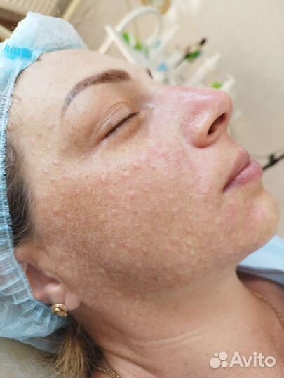 Косметолог, ботокс, био, мезо