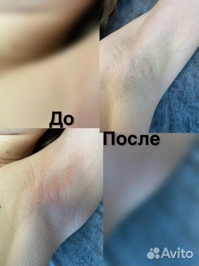 Шугаринг сахарная депиляция