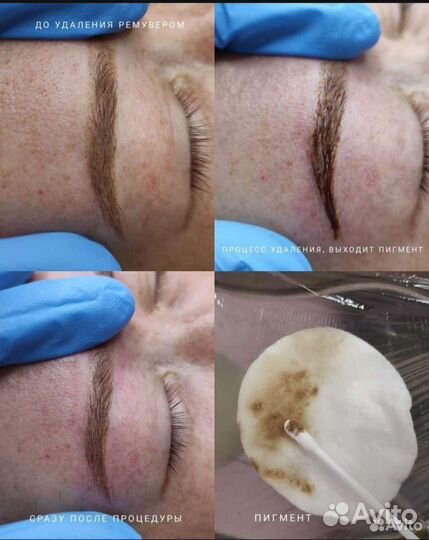 Удаление некачественного татуажа с ремовером