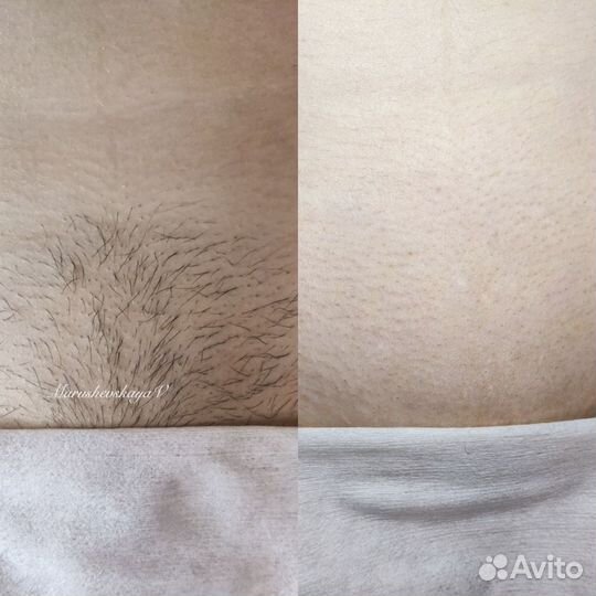 Электроэпиляция для мужчин и женщин