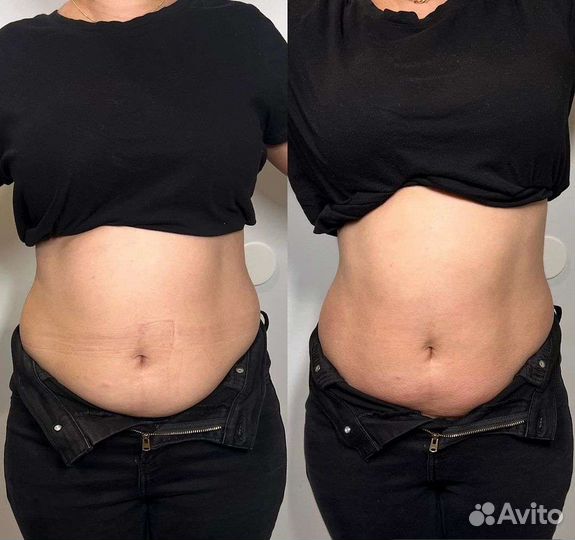 Массаж уз кавитация