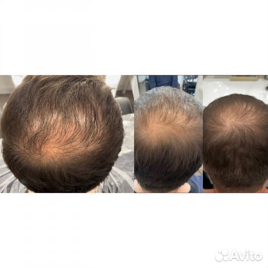 Мезотерапия головы/Восстановление роста волос