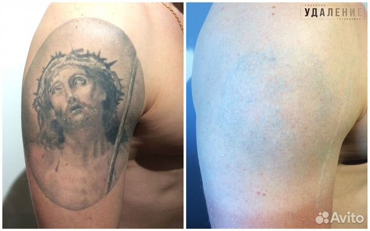 Лазерное удаление тату