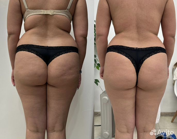 Аппаратный массаж R-Sleek Балтийская Жемчужина