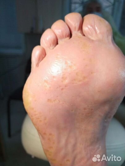 Медицинский педикюр подолог