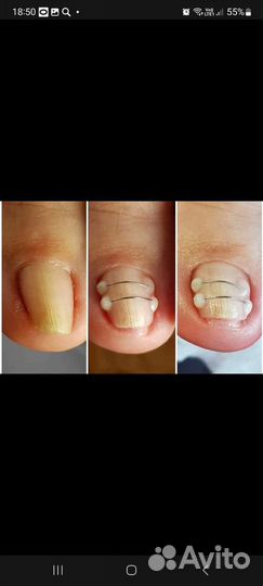 Коррекция вросшего ногтя