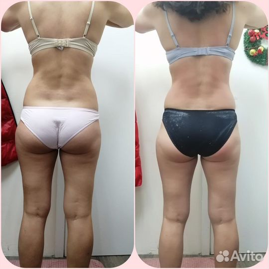 LPG Вакуумно-баночный Антицеллюлитный массажи