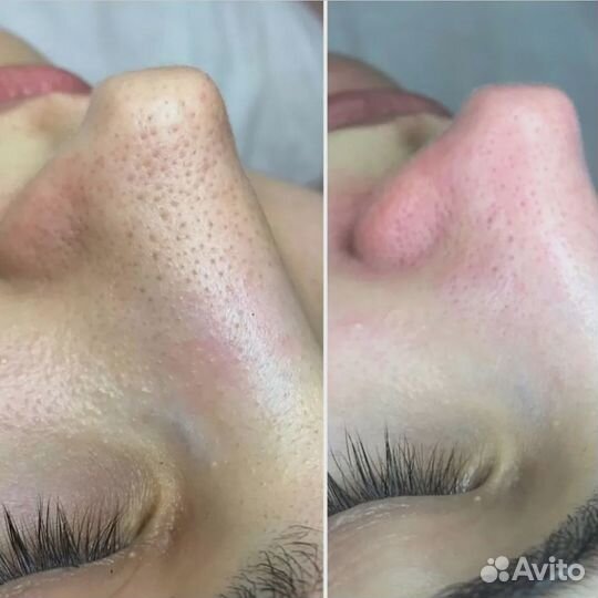 Чистка лица, Скульптурный массаж лица