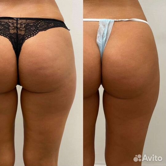 LPG массаж, Классический, Кавитация,smas-лифтинг