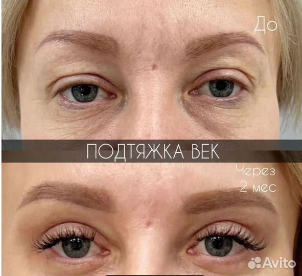 Подтяжка лица за 1 процедуру. СМАС лифтинг