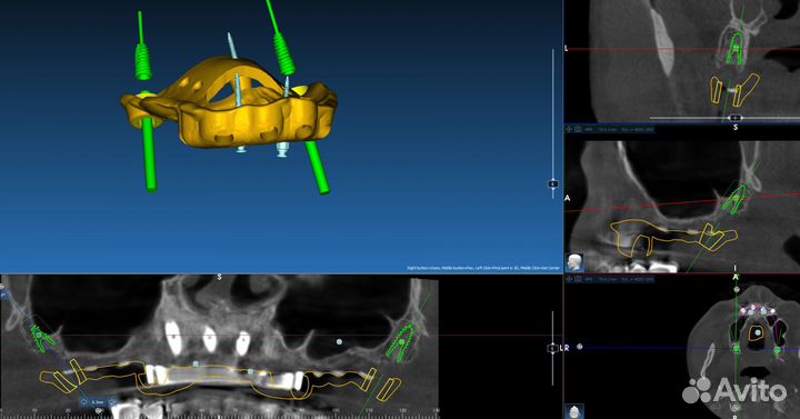 Хирургический шаблон RealGuide,BlueSkyPlan,ExoCad
