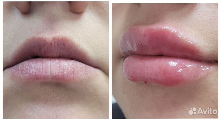 Услуги косметолога. Лечение акне