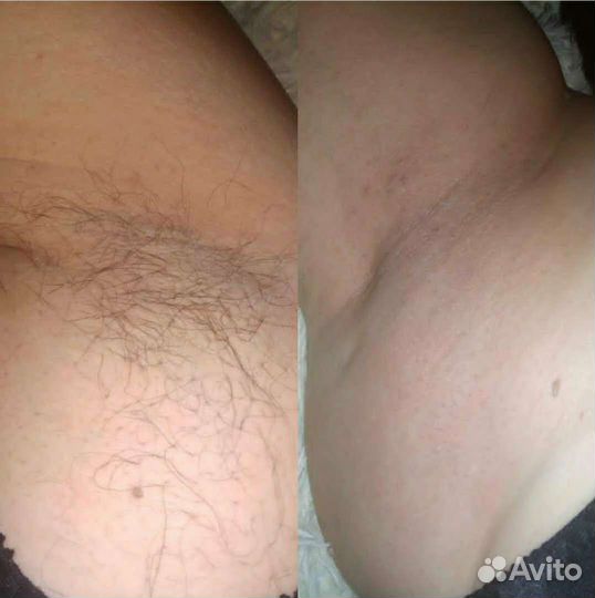 SPA-шугаринг/ваксинг