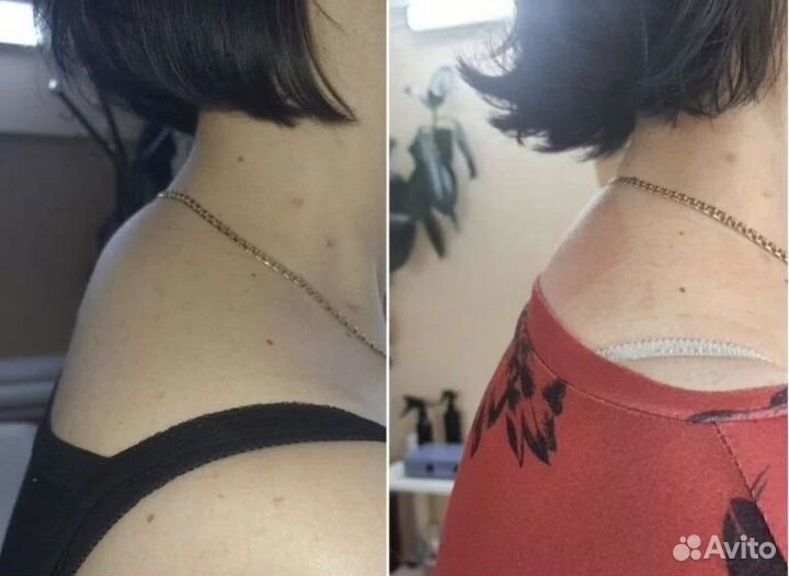 Плоский живот - размер за 1 процедуру В Тольятти