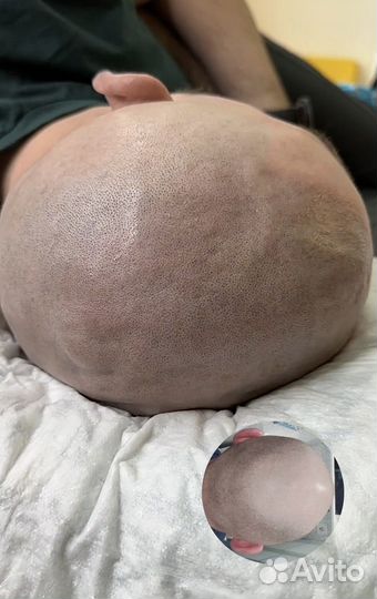 Трихопигментация SMP в Санкт-Петербурге