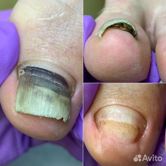 Педикюр,подологические услуги с выездом на дом