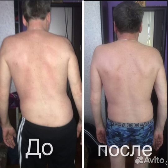 Миопрессура. Акупрессура. Миофасциальная терапия