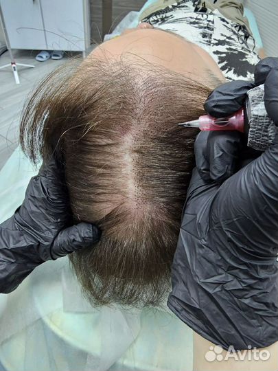 Трихопигментация головы