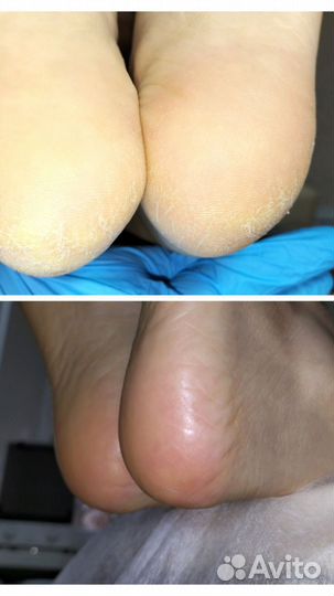 Педикюр подолог
