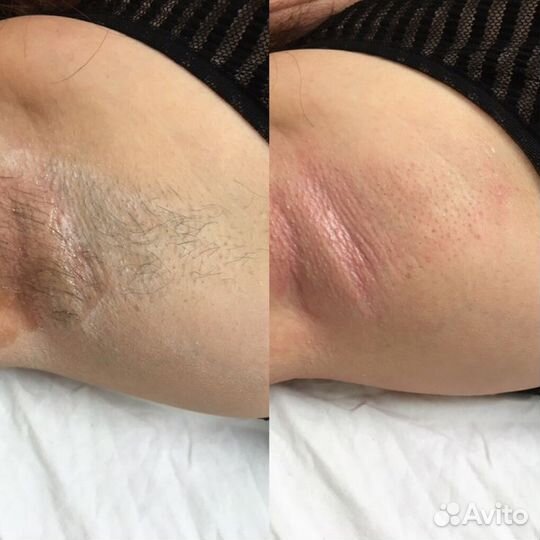 Депиляция на Студенческой