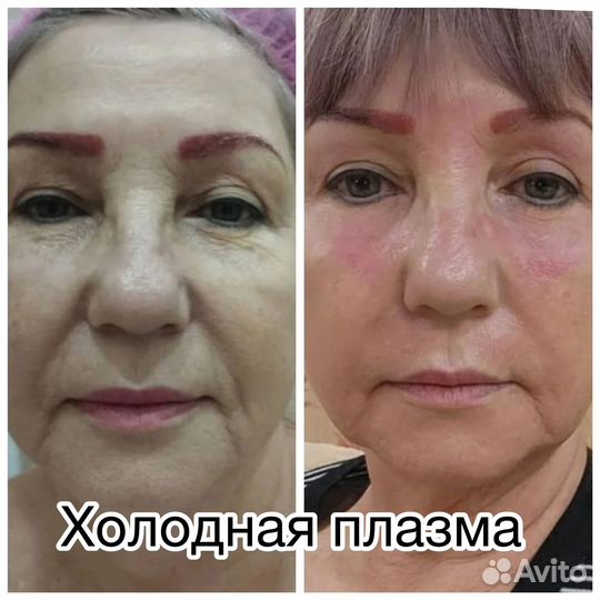Холодная плазма