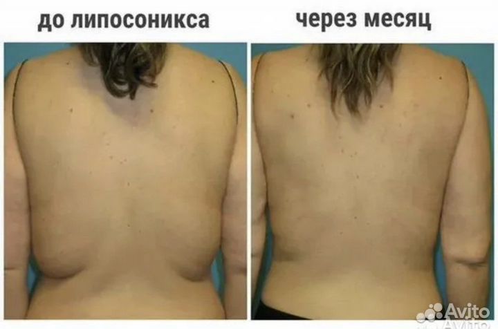 Липосакция без операции. Liposonix
