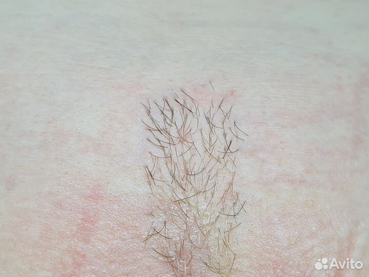 Электроэпиляция