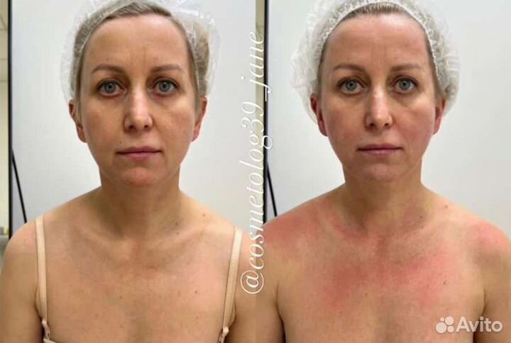 Скульптурный массаж лица