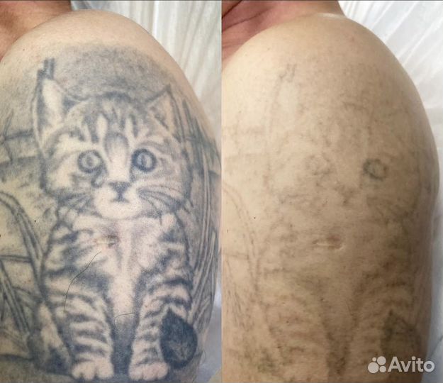 Лазерное удаление тату и татуажа