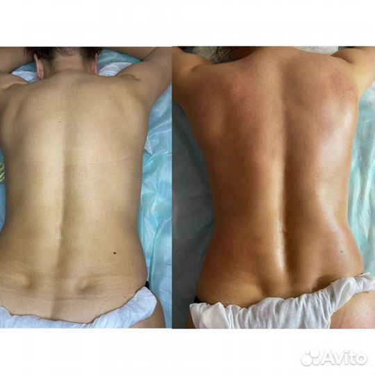 LPG массаж/Кавитация/RF лифтинг/Биотоки