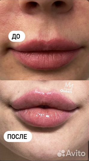 Косметолог. Губы. Ботокс